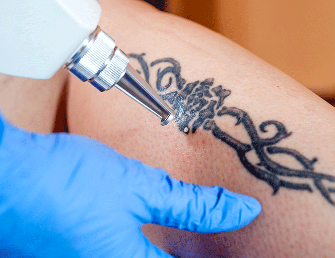 Laser Tattoo Removal | Alert Cairns