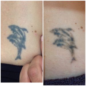Laser Tattoo Removal | Skin Alert Cairns